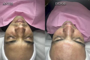 Procedimento antes e depois