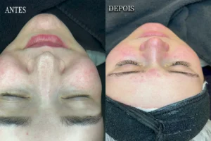 Procedimento Antes e depois