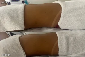 Drenagem linfática antes e depois