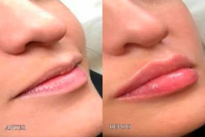 Hidralips procedimento antes e depois