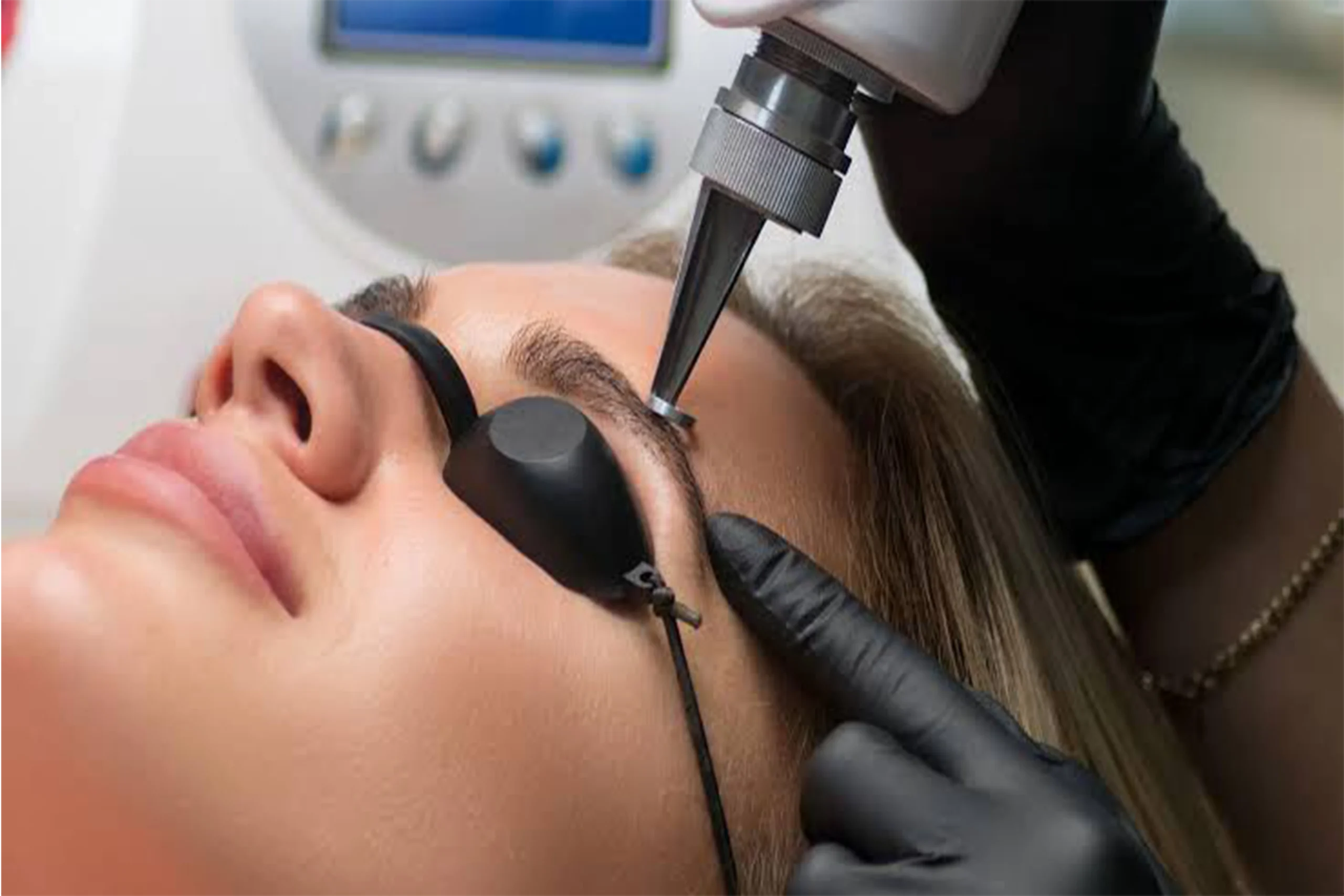 Mulher realizando remoção de pigmentação