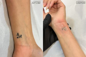 Remoção de Tatoo