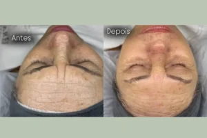 Procedimento antes e depois